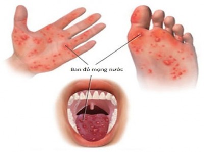 TUYÊN TRUYỀN BỆNH TAY CHÂN MIỆNG