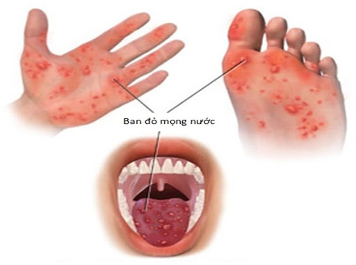 TUYÊN TRUYỀN BỆNH TAY CHÂN MIỆNG